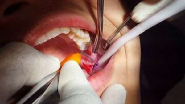 Хирургическое лечение перелома зуба